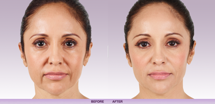 Juvederm Before and After