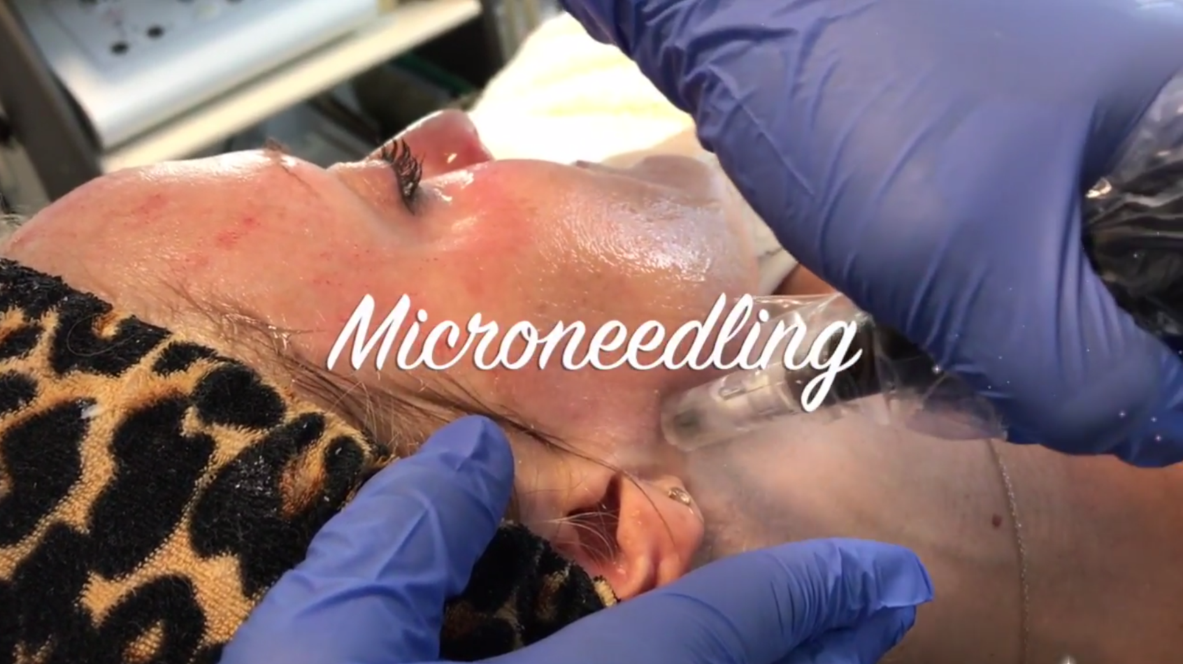 Microneedling: Collagen P.I.N.