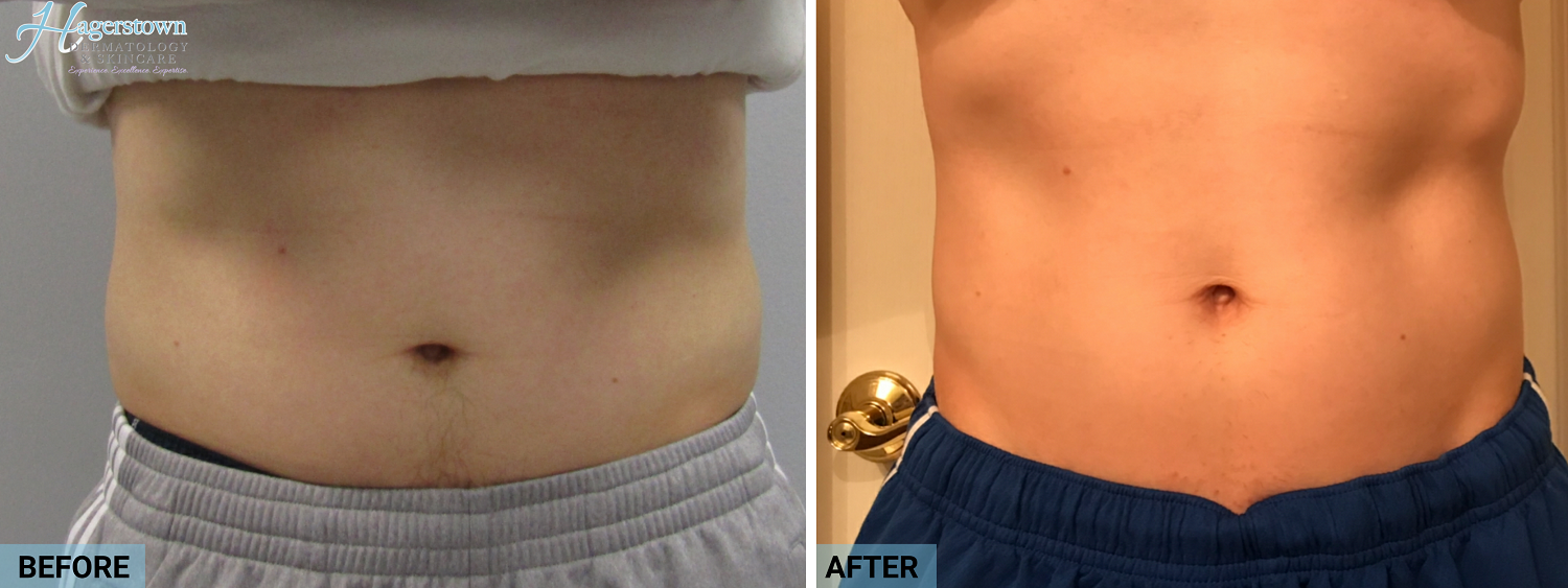 truSculpt Before & After