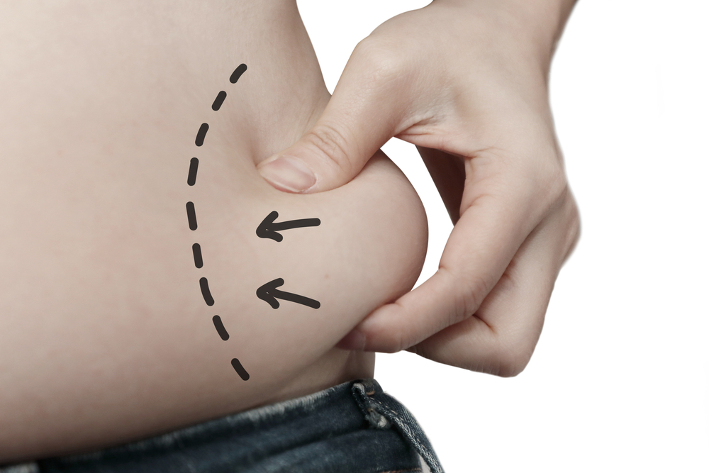 Liposuction vs. truSculpt 3D