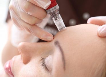 Anti-Aging Treatments: How Microneedling is Changing the Game