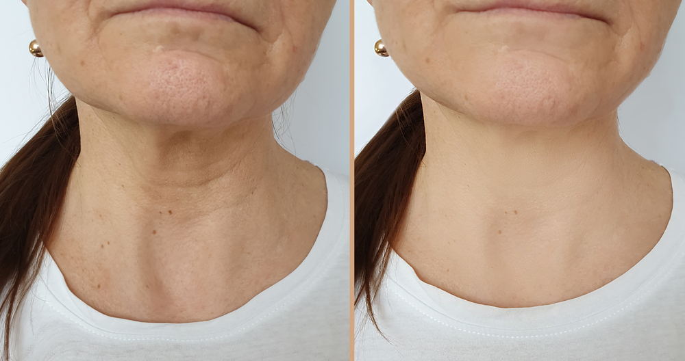 Woman,Neck,Wrinkles,Before,And,After,Treatment - Hagerstown