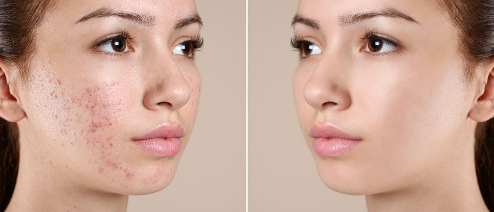 How Long Does an Acne Facial Last for Clearer Skin?