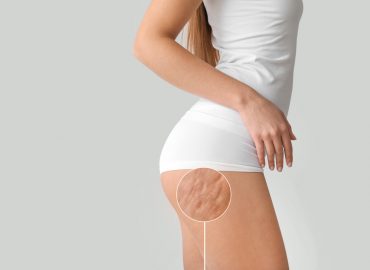5 Reasons Why QWO is the Best Cellulite Treatment