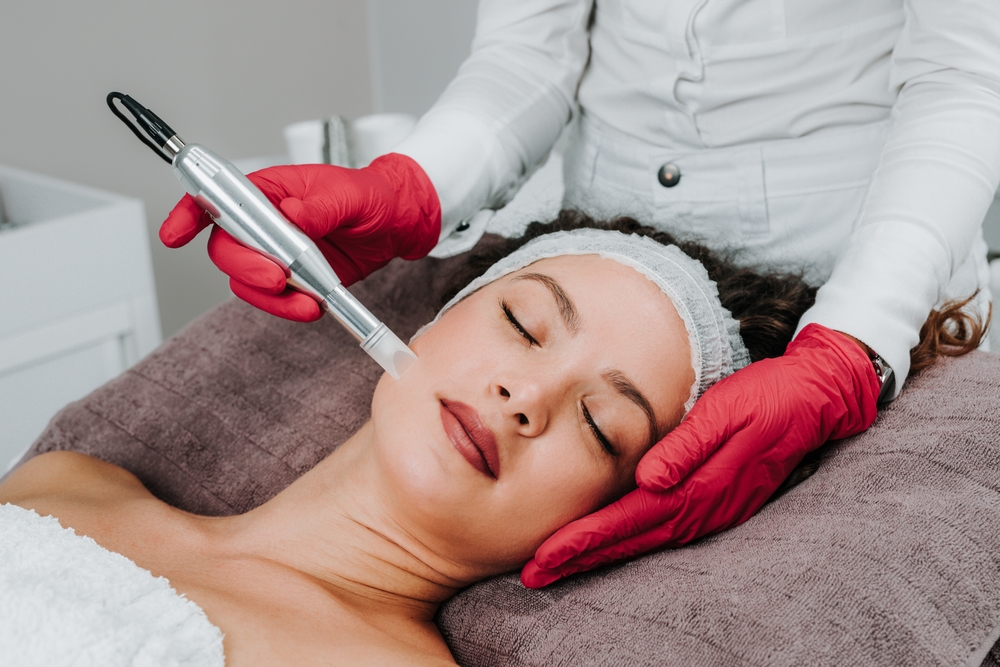 Microneedling With PRP