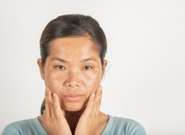 How Can I Reduce Dark Spots on My Face?