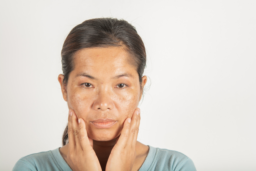 How Can I Reduce Dark Spots on My Face?