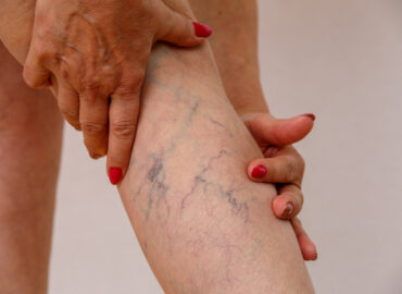Best Varicose Vein Treatment in Hagerstown: Your Top 2 Options