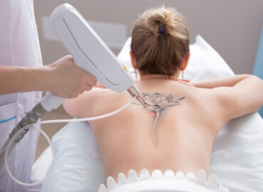 Best Tattoo Removal Cost in Hagerstown: How Much Is It?