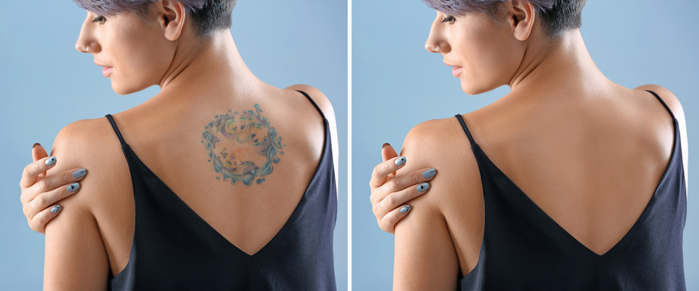 Laser Tattoo Removal Blog | Mobile Tattoo Removal Experts | Page 1