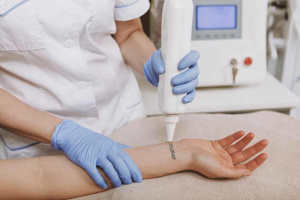 Is Laser Treatment the Best Tattoo Removal Option in Hagerstown, Maryland?