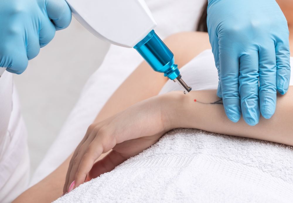 The Truth About the Laser Tattoo Removal Cost in Chambersburg, Pennsylvania