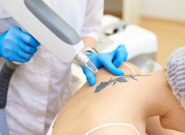 Here's Why the Best Tattoo Removal Near Frederick, Maryland Is a Laser