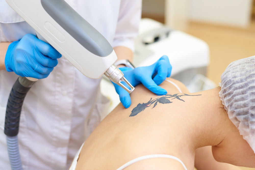 Here’s Why the Best Tattoo Removal Near Frederick, Maryland Is a Laser