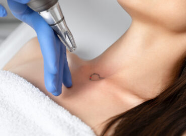What Is the Best Tattoo Removal Cost in Frederick, Maryland?