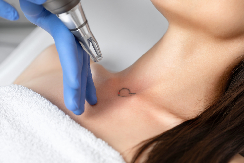 What Is the Best Tattoo Removal Cost in Frederick