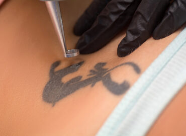 Best Tattoo Removal in Chambersburg, PA