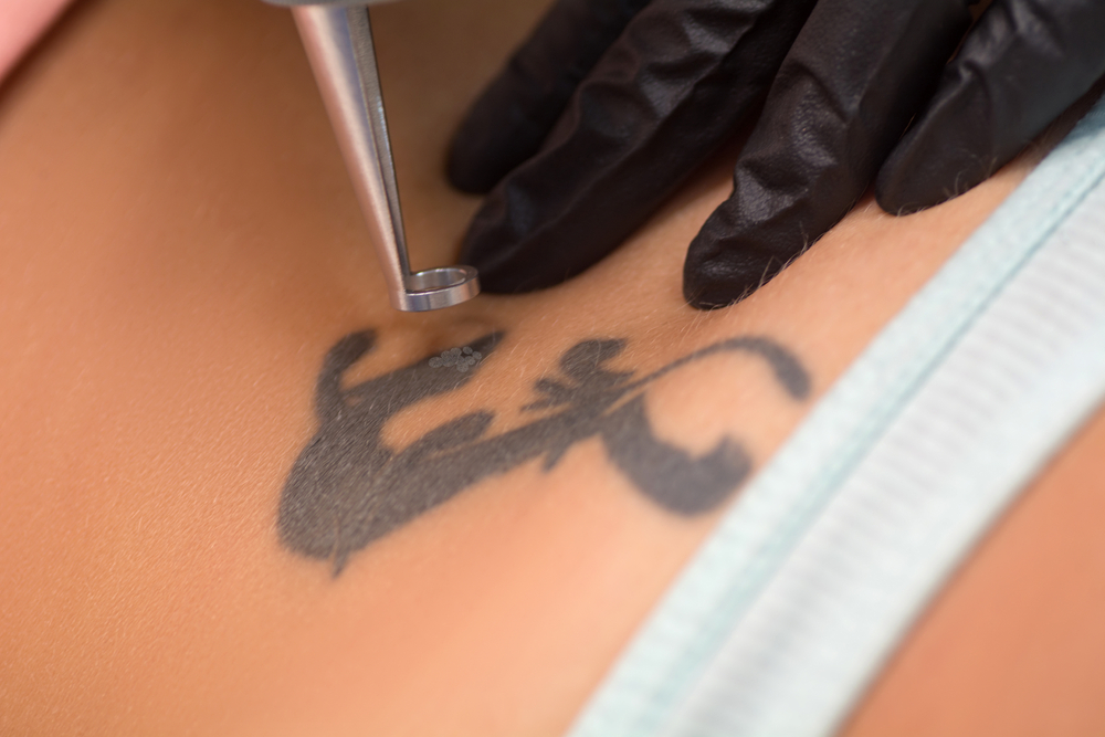 Best Tattoo Removal in Chambersburg, PA