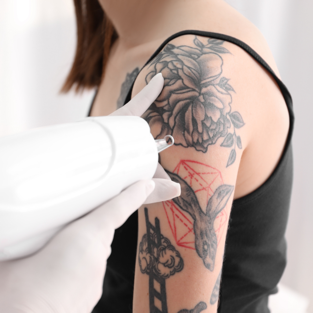 Best Tattoo Removal in Greencastle Pennsylvania