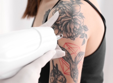 How to Find the Best Tattoo Removal in Greencastle, Pennsylvania
