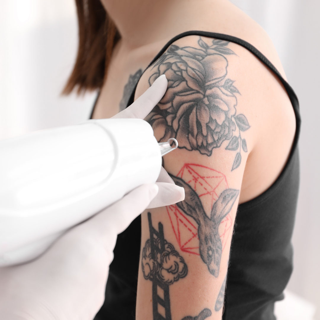 How to Find the Best Tattoo Removal in Greencastle, Pennsylvania