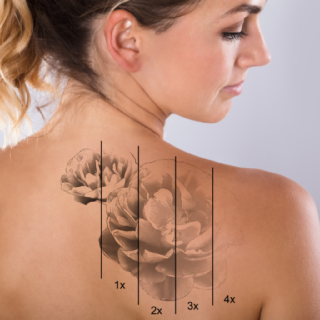 Best Tattoo Removal Cost by Size in Urbana Maryland