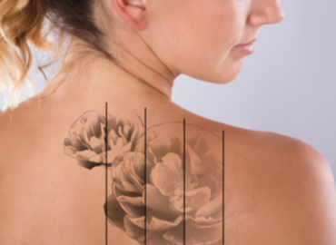Breaking Down the Best Tattoo Removal Cost by Size in Urbana, Maryland