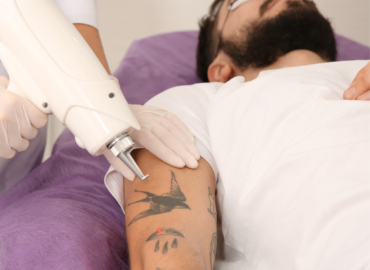 Step-by-Step Guide to the Best Tattoo Removal in Waynesboro, Pennsylvania