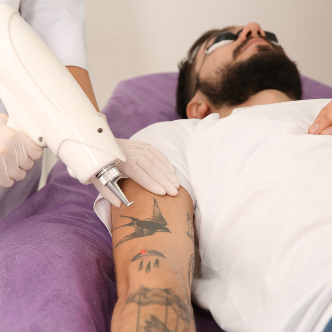 Step-by-Step Guide to the Best Tattoo Removal in Waynesboro, Pennsylvania