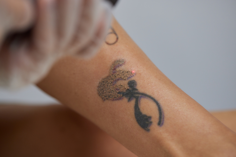 Budgeting for Tattoo Removal Cost in Mercersburg