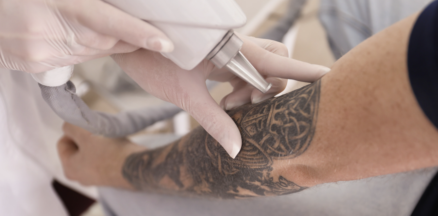 Tattoo Removal Pricing Near Waynesboro Pennsylvania