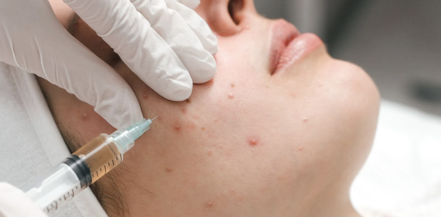 Acne Treatment Appointment in Hagerstown MD