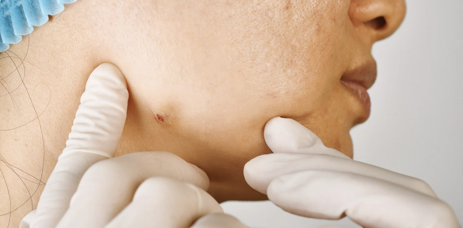 Cystic Acne Specialist Near Hagerstown MD