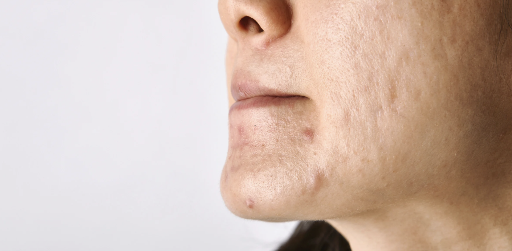 Acne Scar Removal Appointment Near Urbana MD
