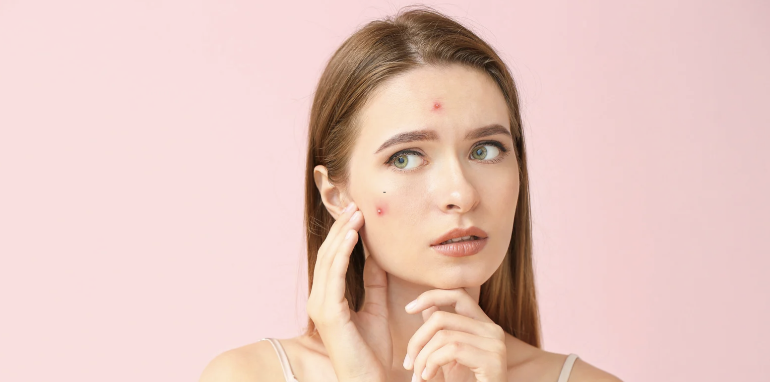 Teen and Adult Acne Management in Hagerstown MD